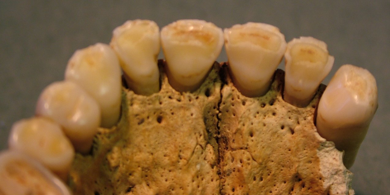 Multiple chipping to the maxillary incisors and canines of SK21