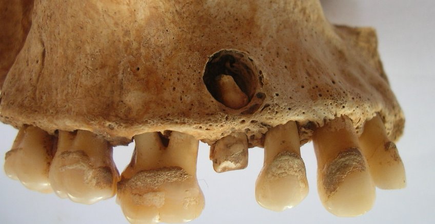 Apicial abscess of the 2nd right maxillary premolar of SK2 